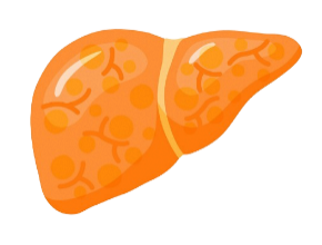 代謝功能異常相關脂肪變性MAS