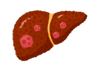 肝細胞癌Hepatocellular Carcinoma