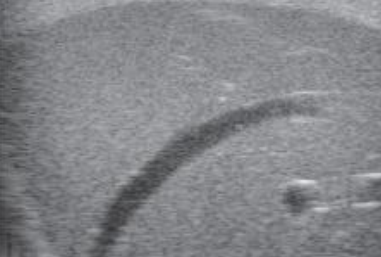 超音波Bモード画像