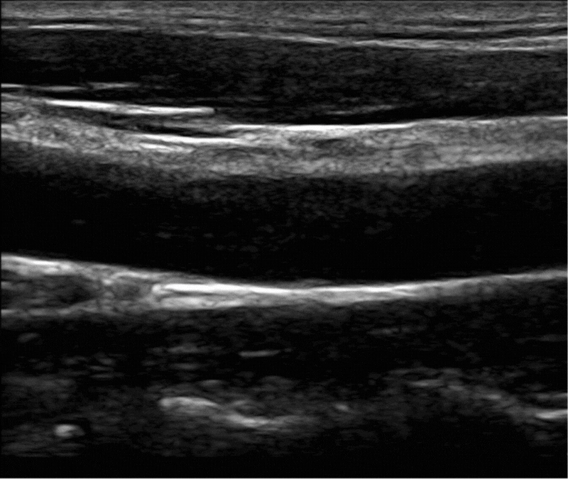 超音波射頻訊號